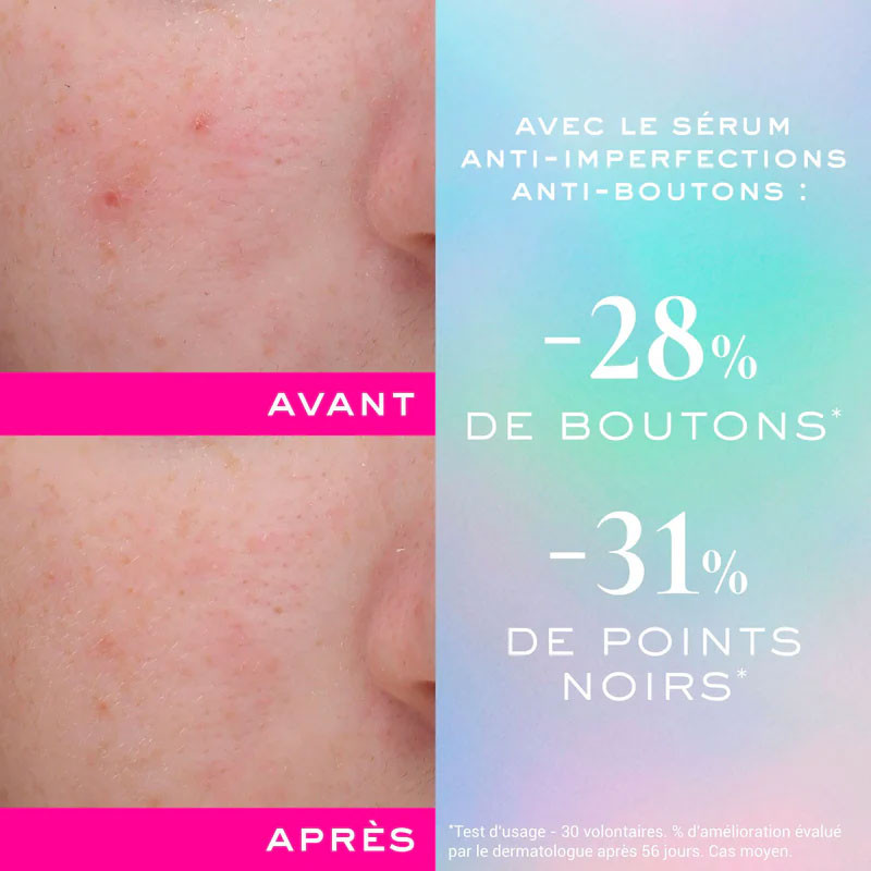 سرم ضد جوش صورت نوکس مدل Zinc Power Blemish and Spot Control مناسب انواع پوست حجم 30 میلی لیتر